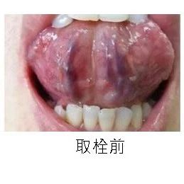 舌下取栓的原理和功效