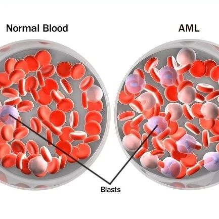AML患者确诊后必须化疗吗？