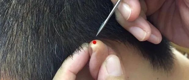耳尖刺血显奇效，多种疾病针到除