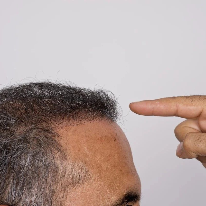 ?脂溢性脱发的治疗方案有哪些？